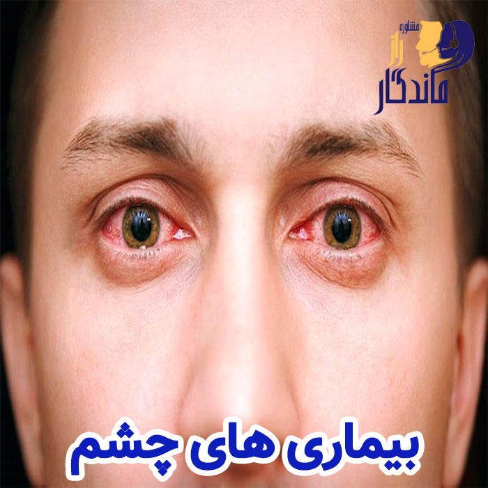 بیماری های چشم